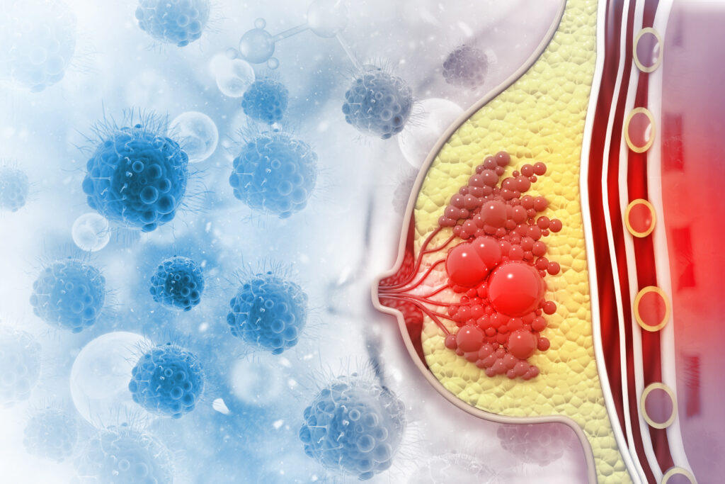 cáncer de mama