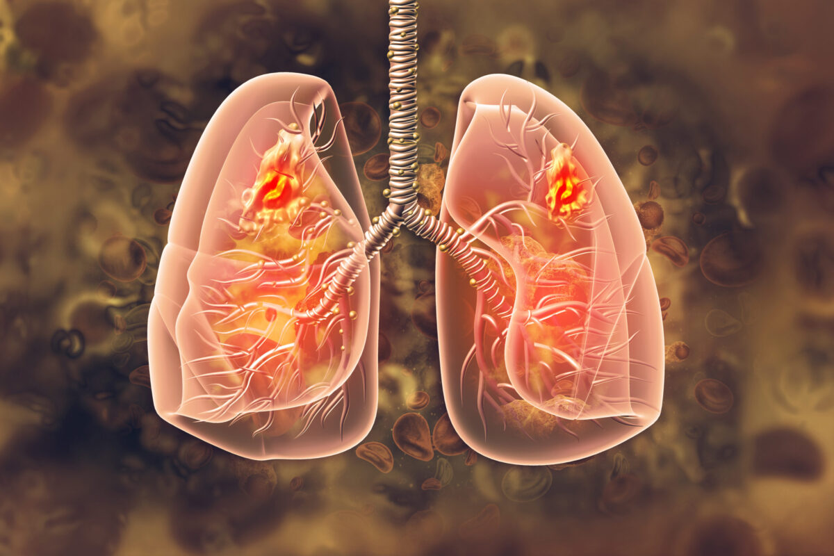 adenocarcinoma