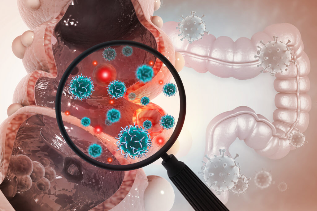 cáncer colorrectal