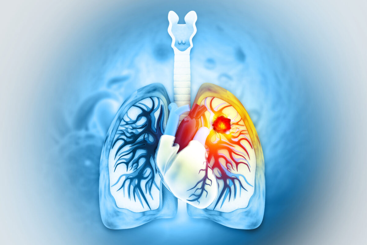 cáncer de pulmón