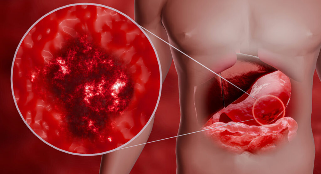cáncer gástrico
