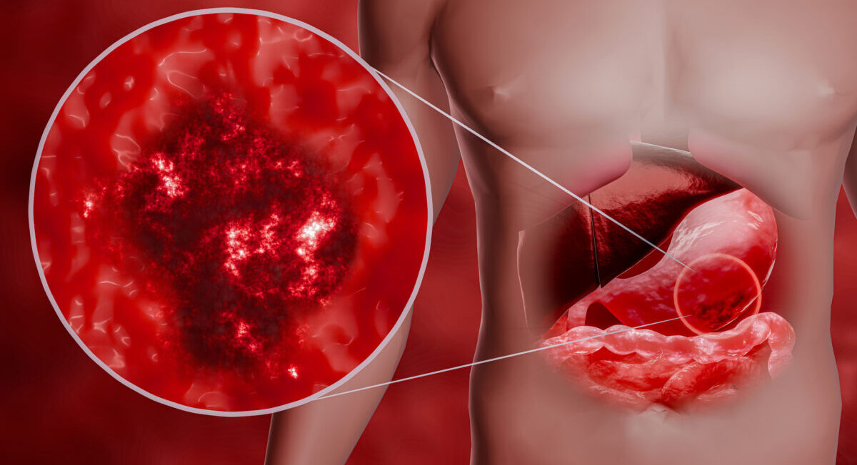 cáncer gástrico