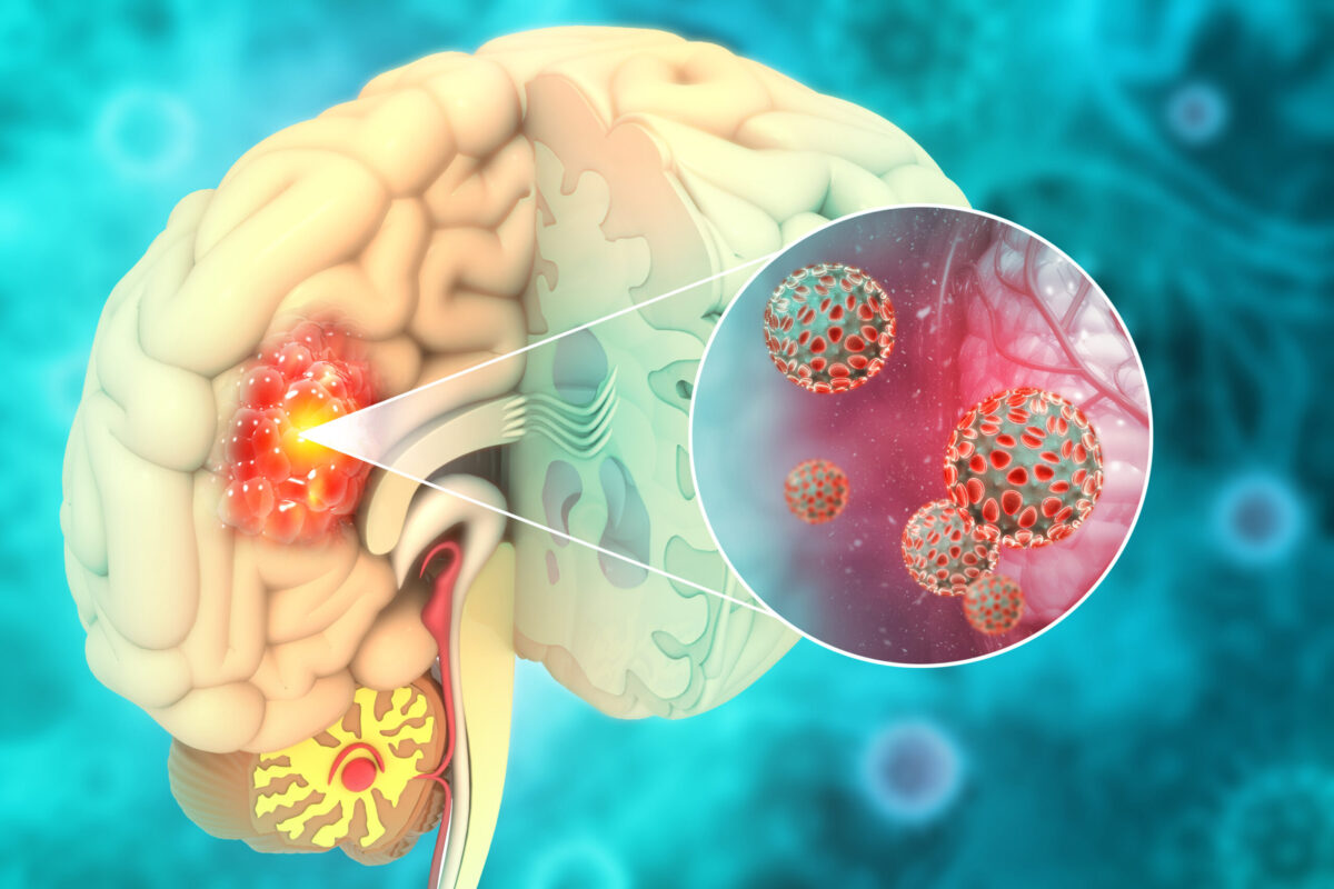 neuroblastoma