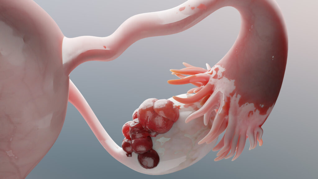 cáncer de ovario