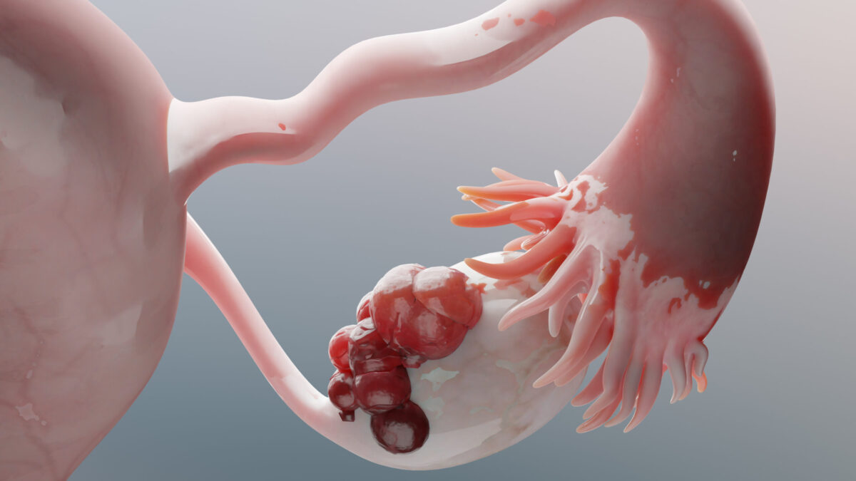 cáncer de ovario