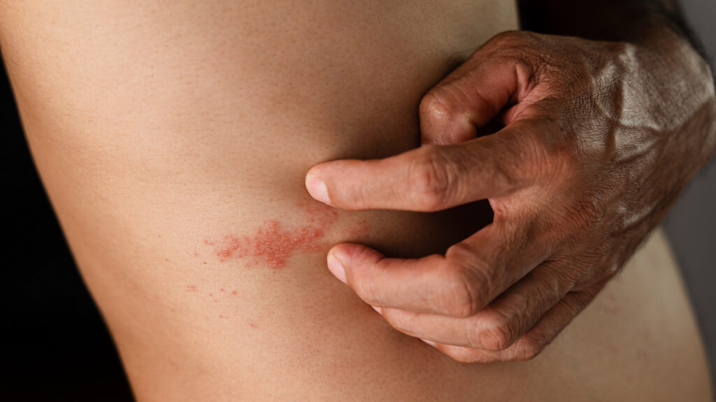 herpes zóster