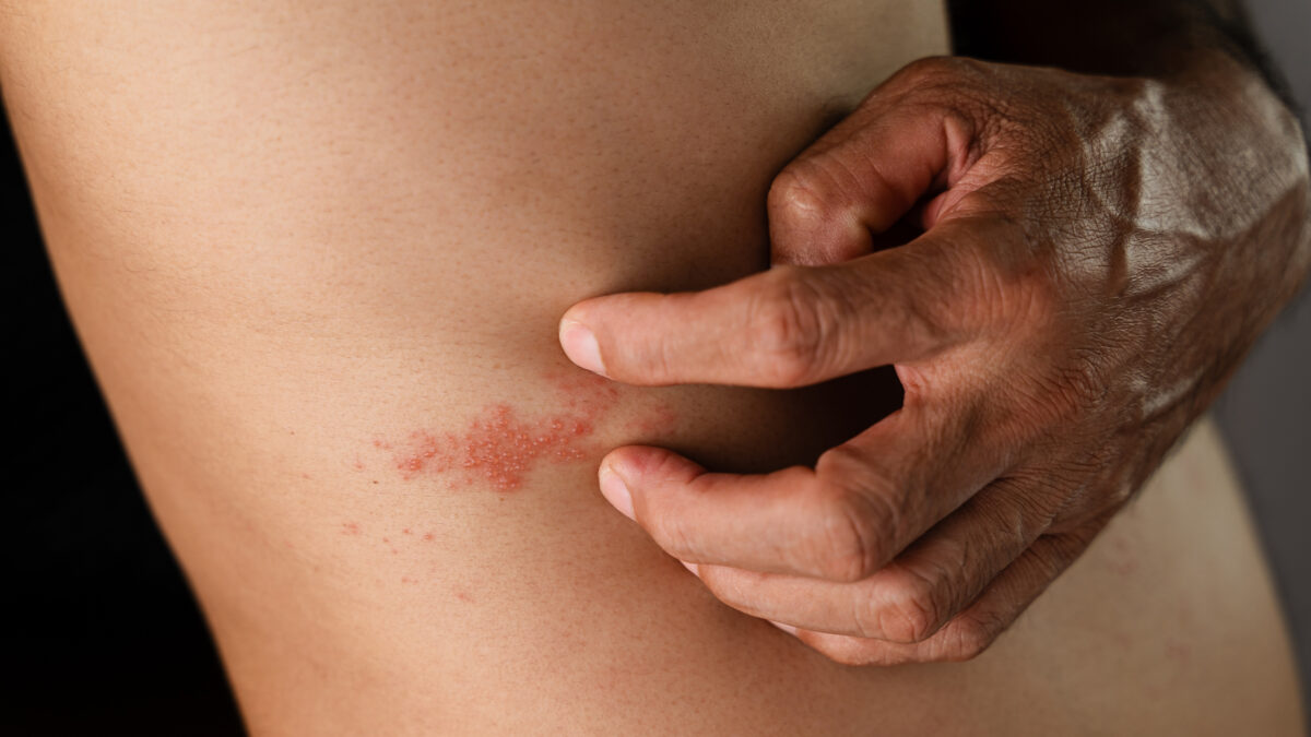 herpes zóster