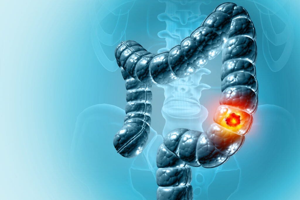 cáncer de colon