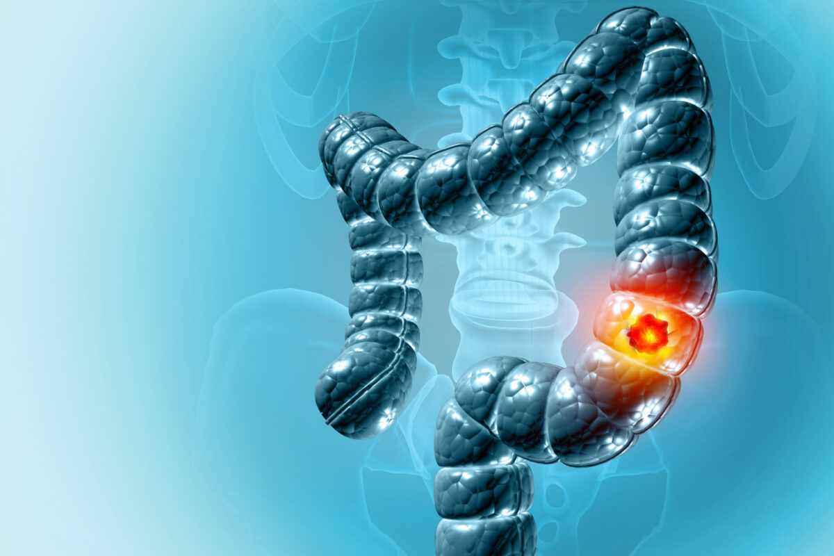 cáncer de colon