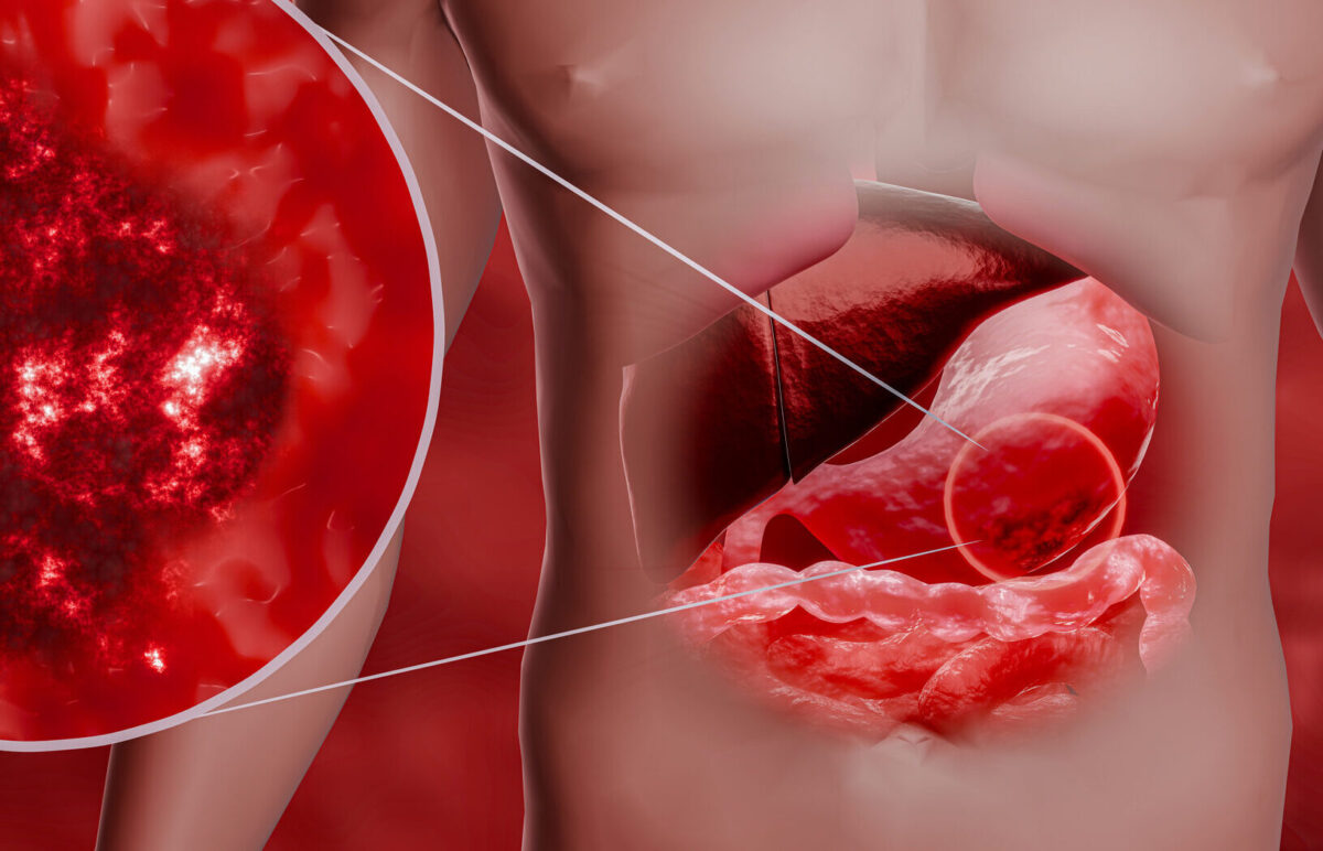 cáncer gástrico