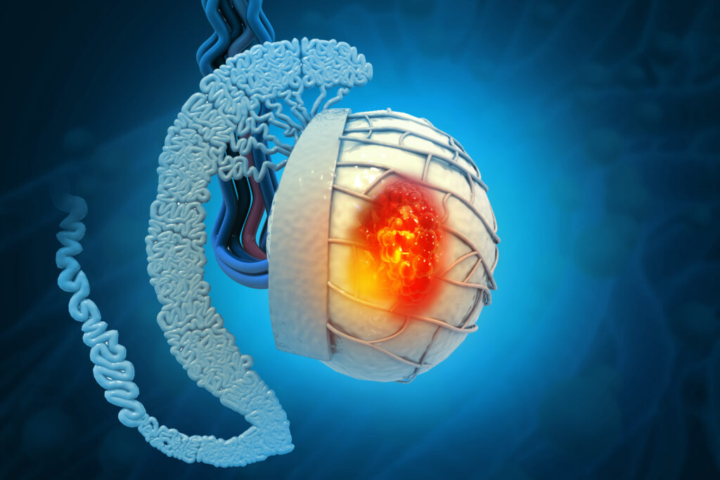 cáncer de testículo